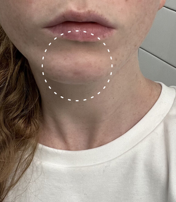 Image of face up close where pimple on chin has healed